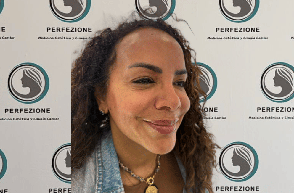 aplicacion-botox-frente-perfezione (14)