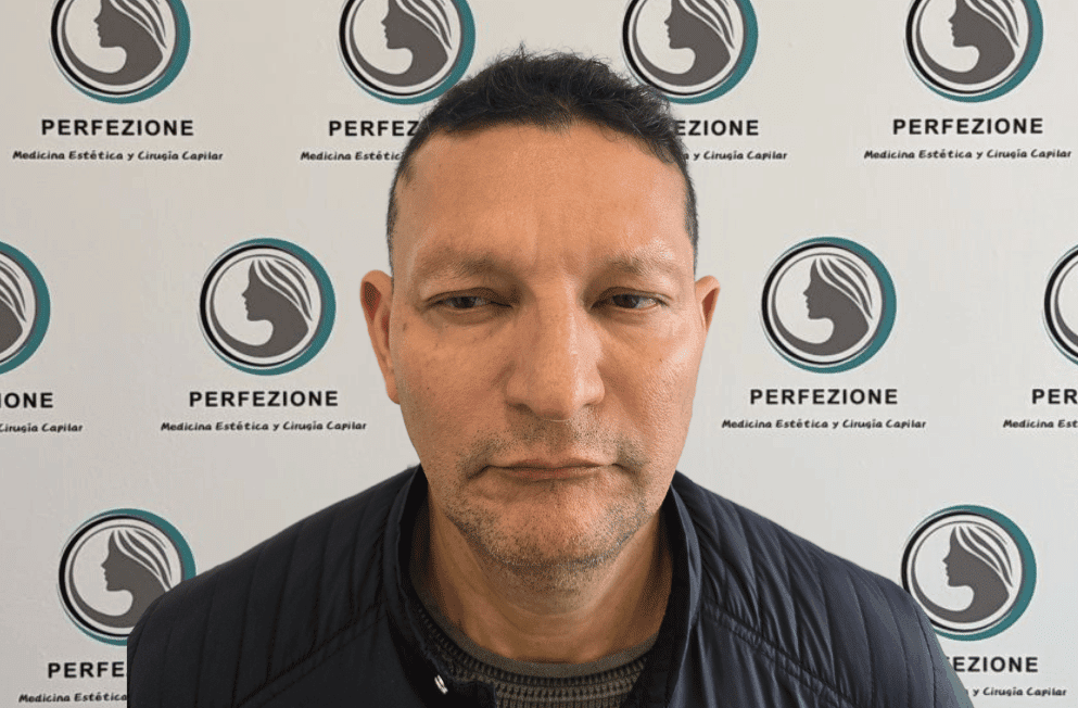 aplicacion-botox-frente-perfezione (21)