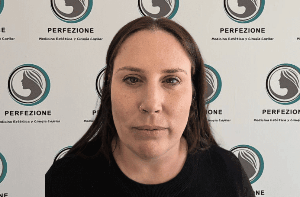 aplicacion-botox-frente-perfezione (3)