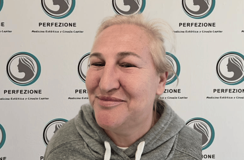 aplicacion-botox-frente-perfezione (6)