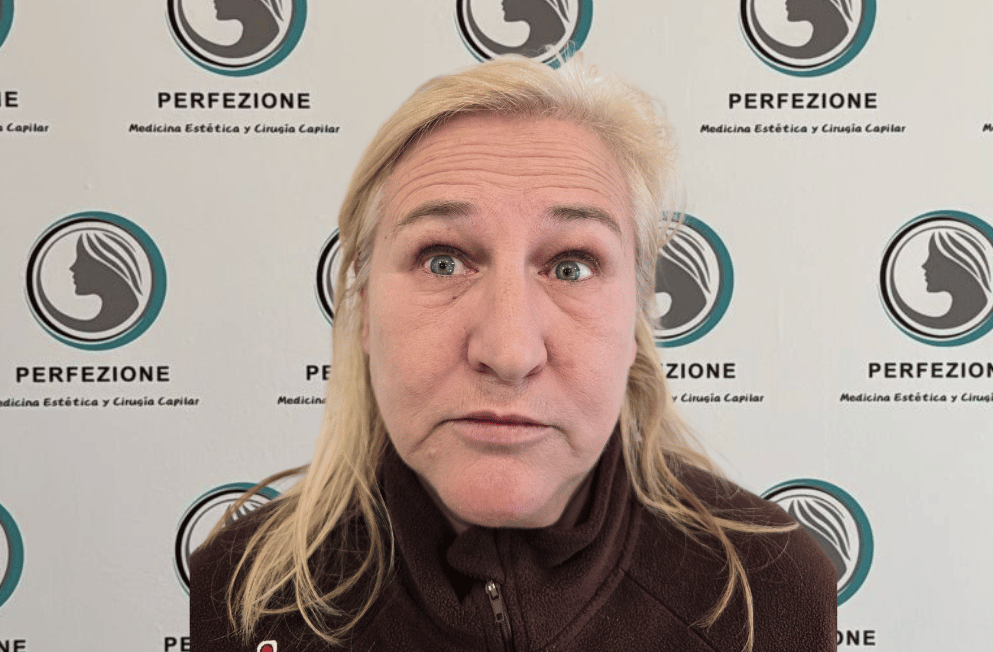 aplicacion-botox-frente-perfezione (7)