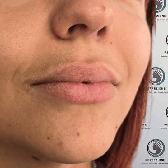 aumento-perfilado-labios-acido-hialuronico-clinica-estetica-madrid (1)