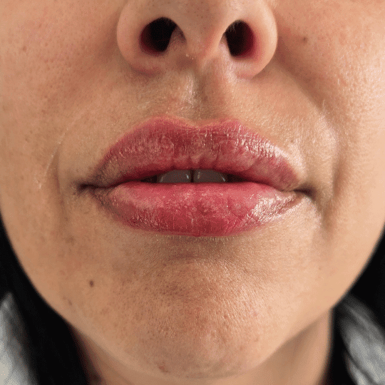 aumento-perfilado-labios-acido-hialuronico-clinica-estetica-madrid (2)