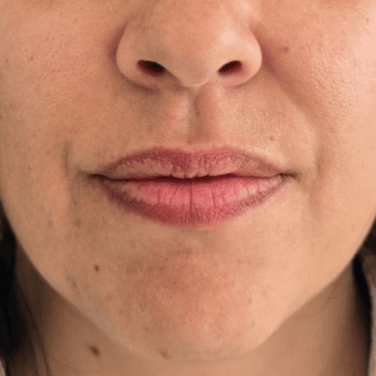 aumento-perfilado-labios-acido-hialuronico-clinica-estetica-madrid (3)