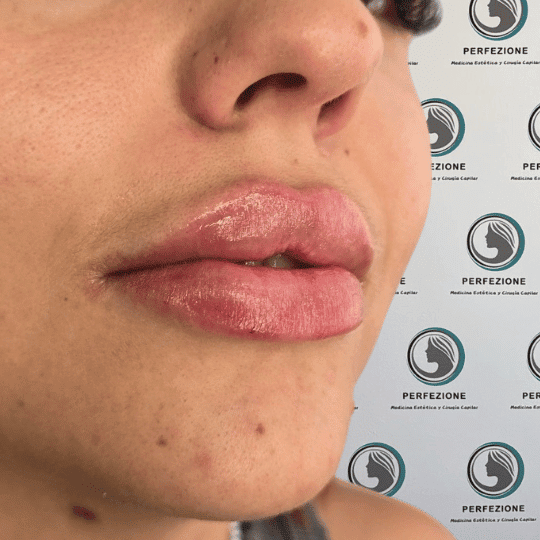 aumento-perfilado-labios-acido-hialuronico-clinica-estetica-madrid (6)