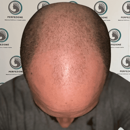 cirugia-capilar-con-tecnica-fue-para-recuperacion-del-cabello-en-hombres-y-mujeres-en-clinica-perfezione-mad (1)
