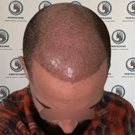 cirugia-capilar-con-tecnica-fue-para-recuperacion-del-cabello-en-hombres-y-mujeres-en-clinica-perfezione-mad (2)