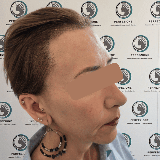 cirugia-capilar-con-tecnica-fue-para-recuperacion-del-cabello-en-hombres-y-mujeres-en-clinica-perfezione-mad (3)
