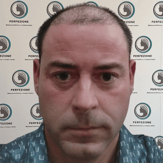 cirugia-capilar-con-tecnica-fue-para-recuperacion-del-cabello-en-hombres-y-mujeres-en-clinica-perfezione-madrid
