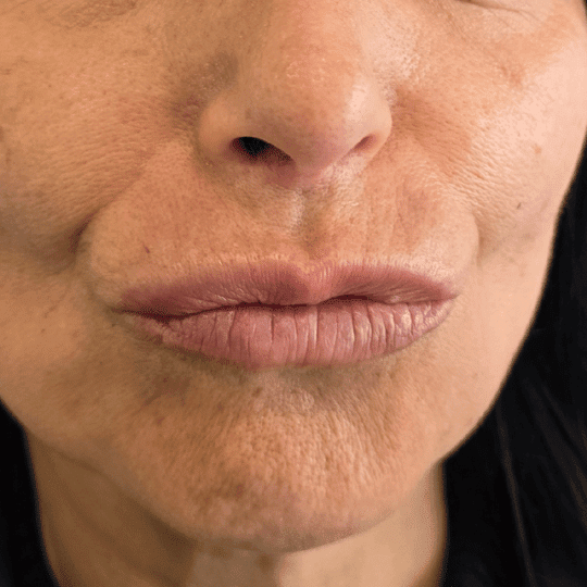 codigo-barras-labios-tratamiento-perfezione (1)