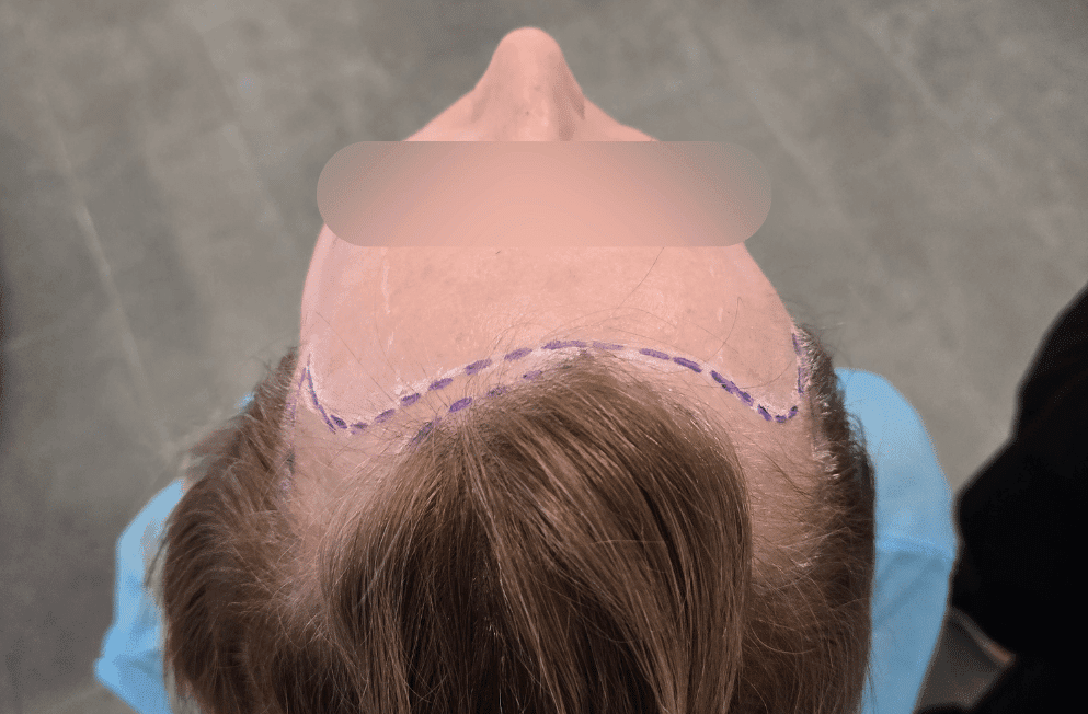 implante-capilar-tecnica-fue-perfezione (1)