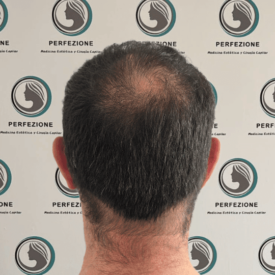 implante-capilar-tecnica-fue-perfezione (1)