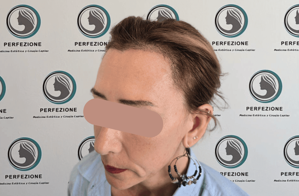 implante-capilar-tecnica-fue-perfezione (10)