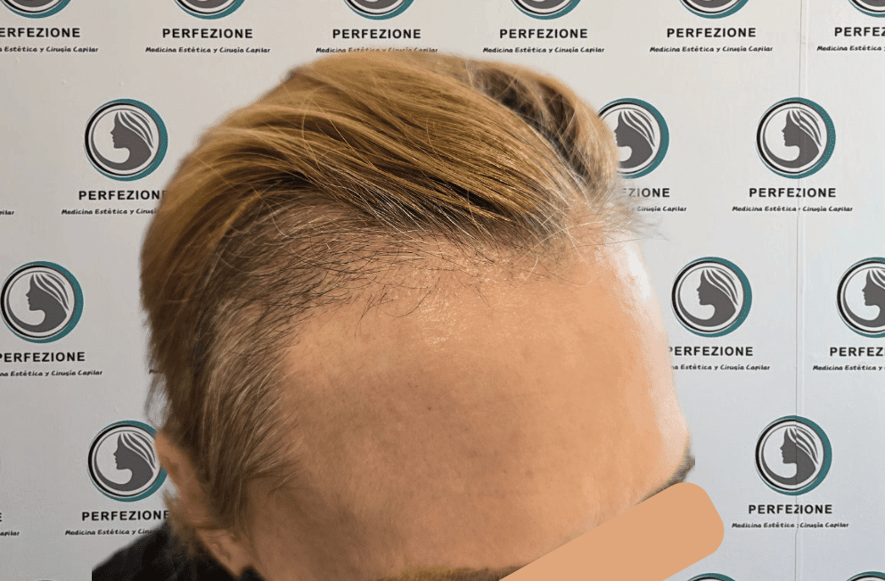 implante-capilar-tecnica-fue-perfezione (11)