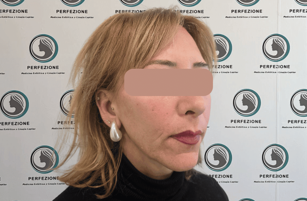 implante-capilar-tecnica-fue-perfezione (12)