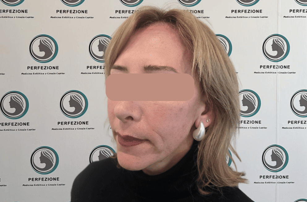 implante-capilar-tecnica-fue-perfezione (13)