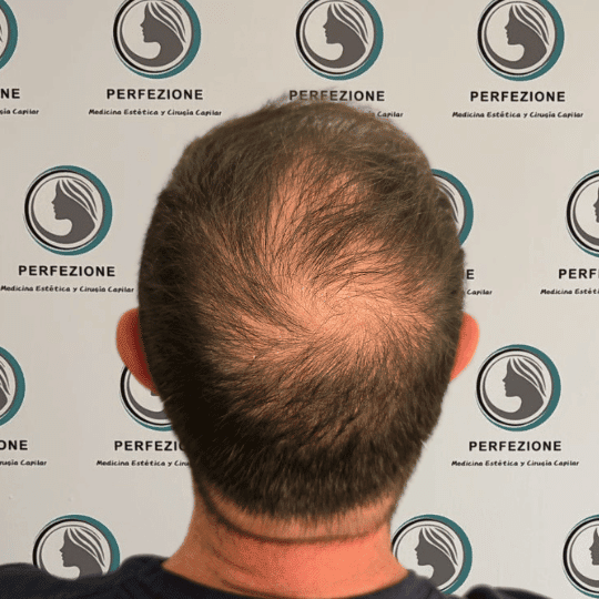 implante-capilar-tecnica-fue-perfezione (2) (1)