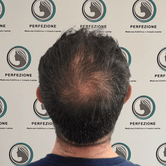 implante-capilar-tecnica-fue-perfezione (3)