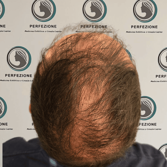 implante-capilar-tecnica-fue-perfezione (4)