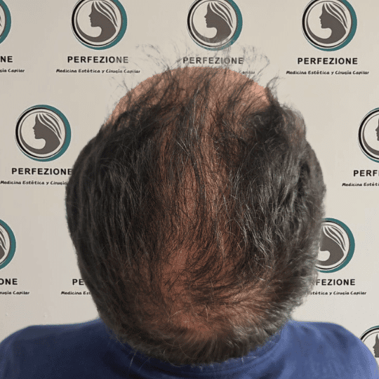 implante-capilar-tecnica-fue-perfezione (5)