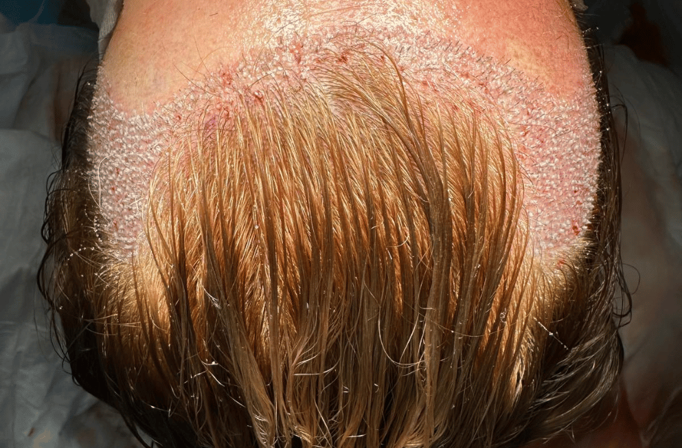 implante-capilar-tecnica-fue-perfezione (6)