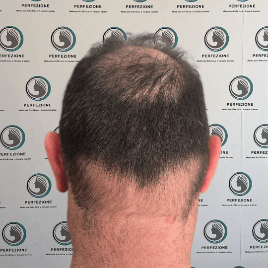 implante-capilar-tecnica-fue-perfezione (6)