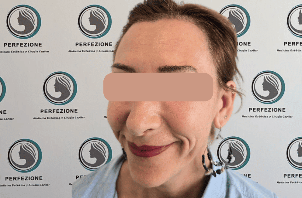 implante-capilar-tecnica-fue-perfezione (8)