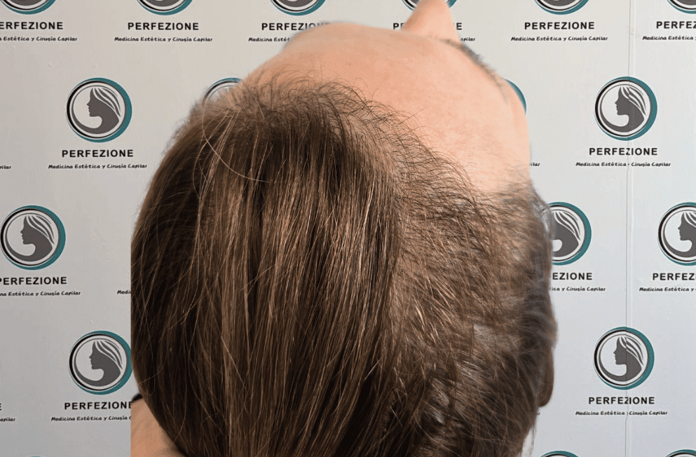 implante-capilar-tecnica-fue-perfezione (9)