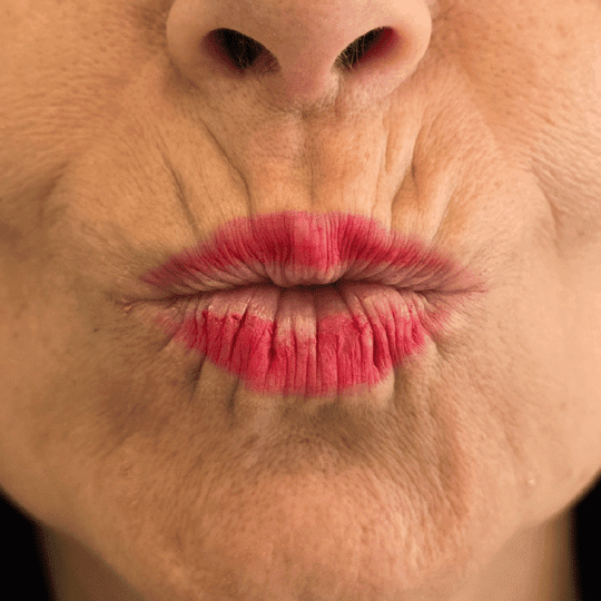 neuromodulador-estetica-clinica-arrugas-expresion-madrid (2)