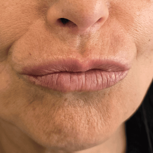 neuromodulador-estetica-clinica-arrugas-expresion-madrid (3)