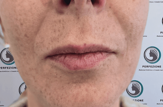 relleno-de-labios-con-acido-hialuronico-para-volumen-natural-y-perfilado-labial-en-clinica-estetica-perfezione-madrid (10)