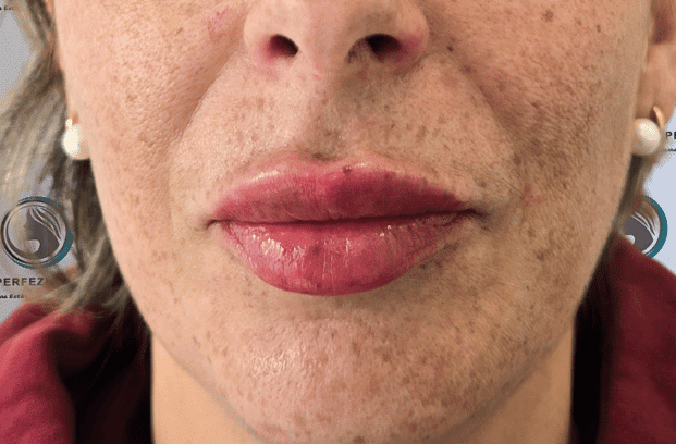 relleno-de-labios-con-acido-hialuronico-para-volumen-natural-y-perfilado-labial-en-clinica-estetica-perfezione-madrid (11)