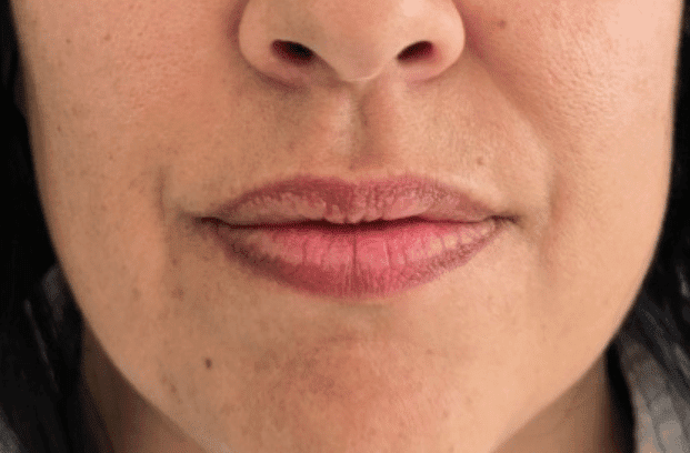 relleno-de-labios-con-acido-hialuronico-para-volumen-natural-y-perfilado-labial-en-clinica-estetica-perfezione-madrid (12)