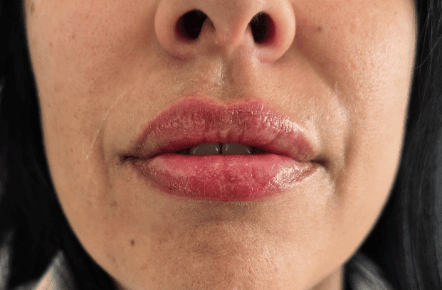relleno-de-labios-con-acido-hialuronico-para-volumen-natural-y-perfilado-labial-en-clinica-estetica-perfezione-madrid (13)