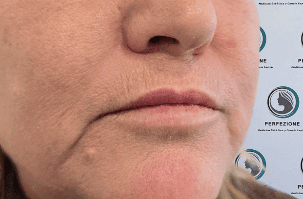 relleno-de-labios-con-acido-hialuronico-para-volumen-natural-y-perfilado-labial-en-clinica-estetica-perfezione-madrid (14)