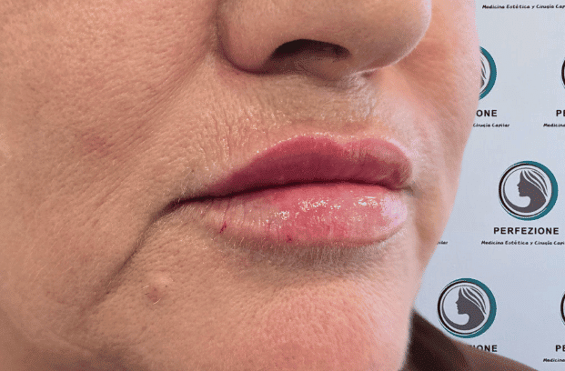 relleno-de-labios-con-acido-hialuronico-para-volumen-natural-y-perfilado-labial-en-clinica-estetica-perfezione-madrid (15)