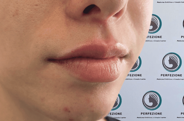 relleno-de-labios-con-acido-hialuronico-para-volumen-natural-y-perfilado-labial-en-clinica-estetica-perfezione-madrid (16)