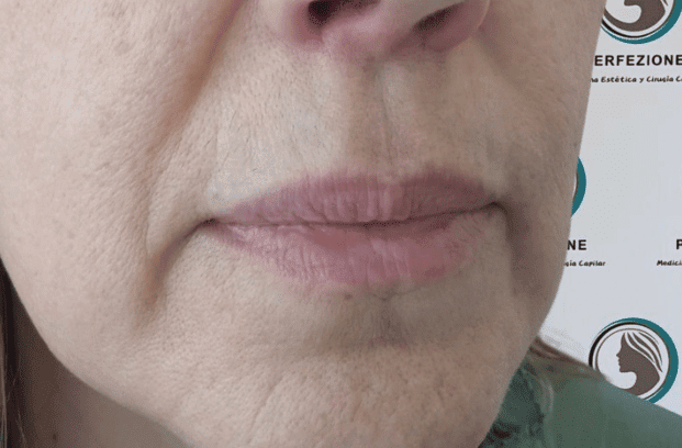 relleno-de-labios-con-acido-hialuronico-para-volumen-natural-y-perfilado-labial-en-clinica-estetica-perfezione-madrid (3)