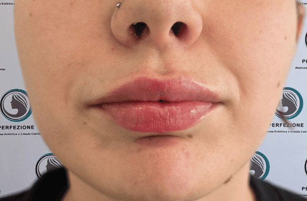 relleno-de-labios-con-acido-hialuronico-para-volumen-natural-y-perfilado-labial-en-clinica-estetica-perfezione-madrid (5)