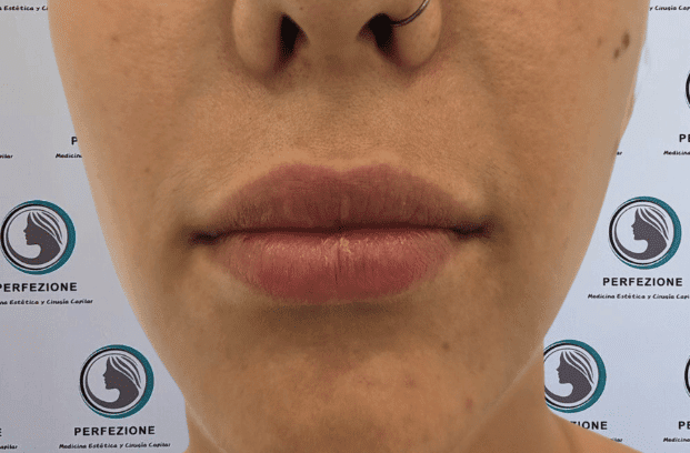 relleno-de-labios-con-acido-hialuronico-para-volumen-natural-y-perfilado-labial-en-clinica-estetica-perfezione-madrid (6)