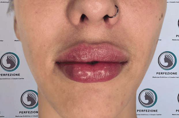relleno-de-labios-con-acido-hialuronico-para-volumen-natural-y-perfilado-labial-en-clinica-estetica-perfezione-madrid (7)