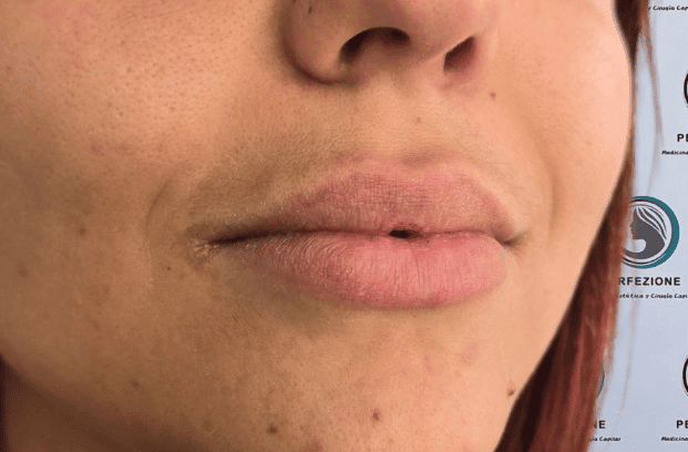 relleno-de-labios-con-acido-hialuronico-para-volumen-natural-y-perfilado-labial-en-clinica-estetica-perfezione-madrid (8)