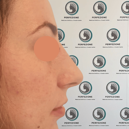 rinomodelacion-sin-cirugia-con-acido-hialuronico-resultados-naturales-clinica-perfezione-madrid