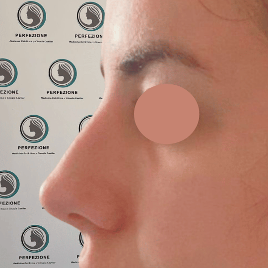 rinomodelacion-sin-cirugia-con-acido-hialuronico-resultados-naturales-clinica-perfezione-madrid1