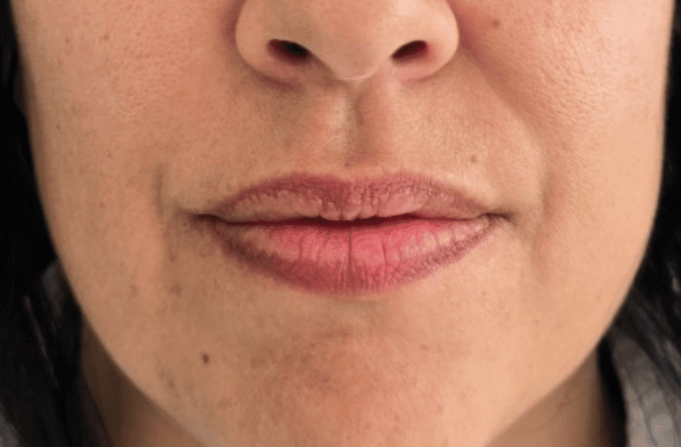 russianlips-relleno-labios-acido-hialuronico-perfezione (10)