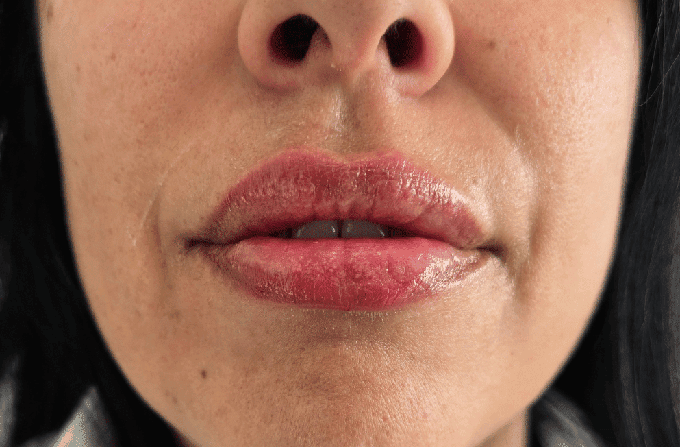 russianlips-relleno-labios-acido-hialuronico-perfezione (11)