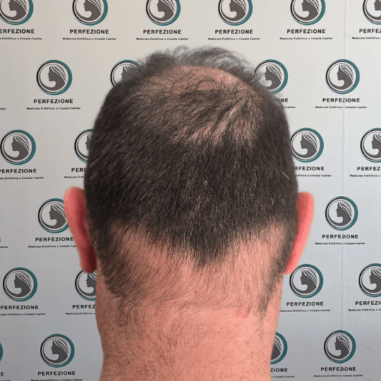 tratamiento-capilar-estetica-clinica-alopecia-mujer-hombre-barcelona (1)