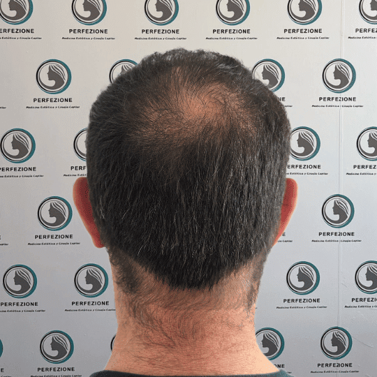 tratamiento-capilar-estetica-clinica-alopecia-mujer-hombre-barcelona (2)