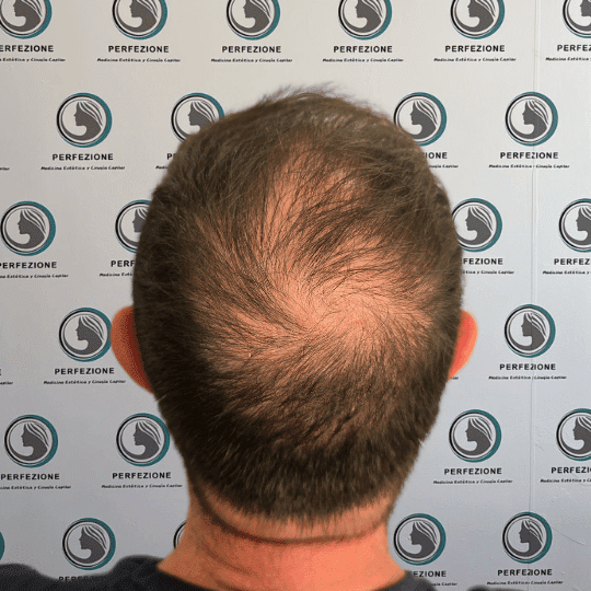tratamiento-capilar-estetica-clinica-alopecia-mujer-hombre-barcelona (3)