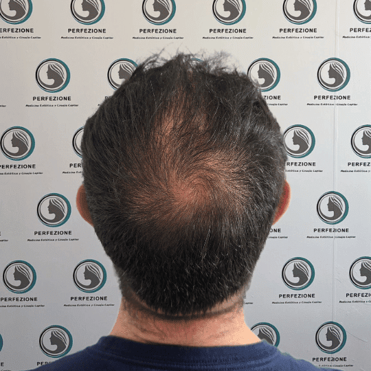 tratamiento-capilar-estetica-clinica-alopecia-mujer-hombre-barcelona (4)
